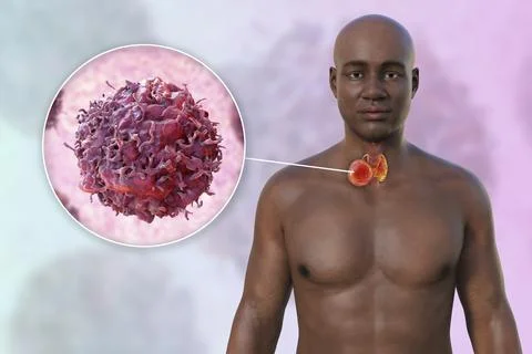 Thyroid cancer, 3D illustration Stock Illustration