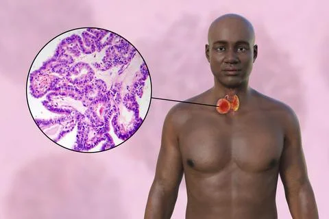 Thyroid cancer, 3D illustration Stock Illustration