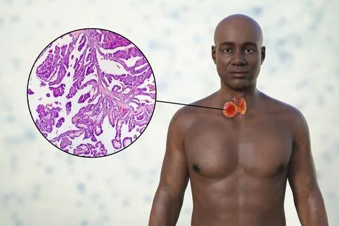 Thyroid cancer, 3D illustration Stock Illustration