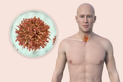 Thyroid cancer, 3D illustration Stock Illustration