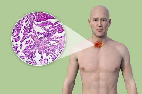Thyroid cancer, 3D illustration Stock Illustration