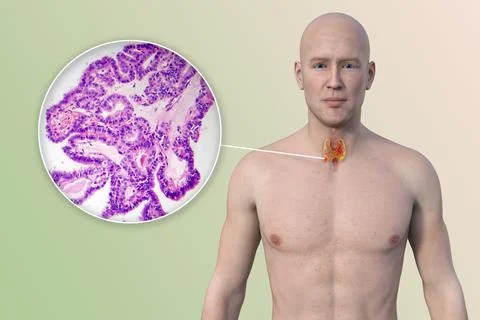 Thyroid cancer, 3D illustration Stock Illustration