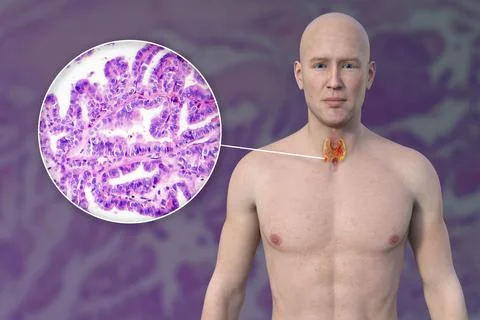 Thyroid cancer, 3D illustration Stock Illustration