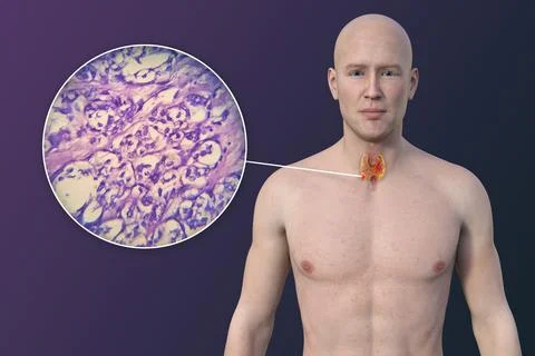 Thyroid cancer, 3D illustration Stock Illustration