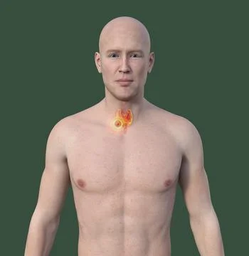 Thyroid cancer, 3D illustration Stock Illustration