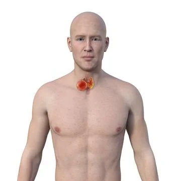 Thyroid cancer, 3D illustration Stock Illustration