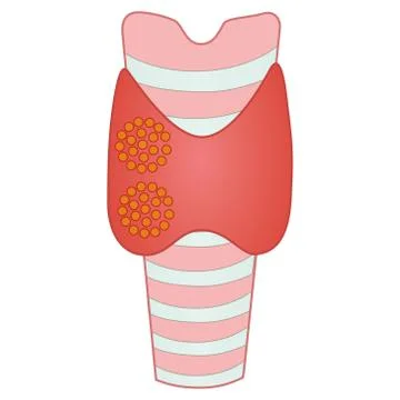 Thyroid Cancer Cell Vector Illustration Stock Illustration