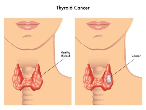 Thyroid cancer Stock Illustration