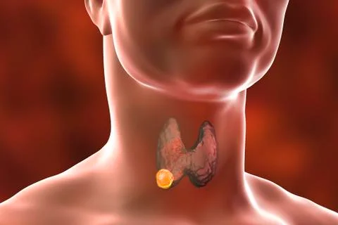 Thyroid cancer. illustration Stock Illustration