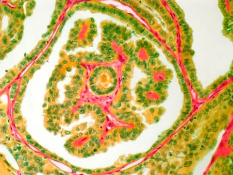 Thyroid cancer; light micrograph Stock Illustration