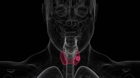 Thyroid cancer is a malignant tumor arising from cells of the thyroid gland, a Stock Footage 342828561