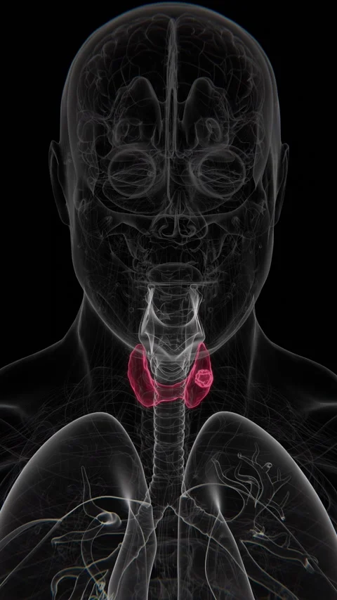 Thyroid cancer is a malignant tumor arising from cells of the thyroid gland, a Stock Footage 342828636