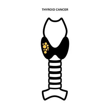 Thyroid cancer stages イラスト素材