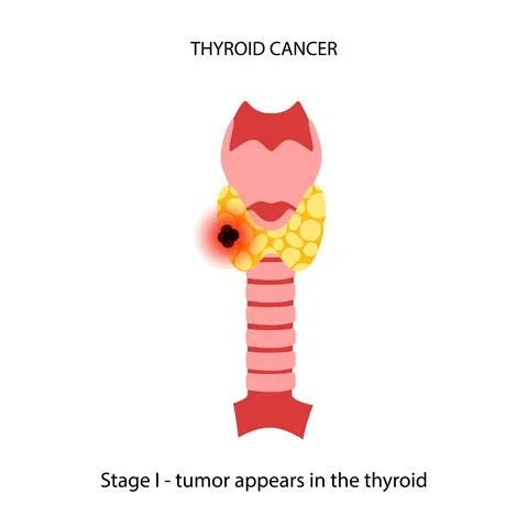 Thyroid cancer stages Illustrazione stock
