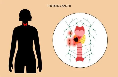 Thyroid cancer stages Stock Illustration