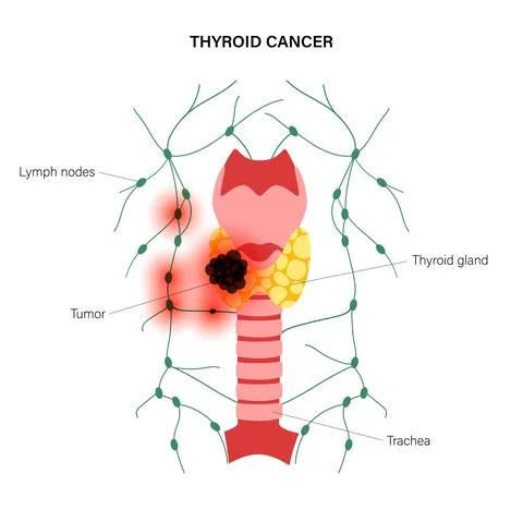 Thyroid cancer stages Stock Illustration