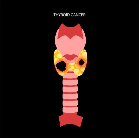 Thyroid cancer stages 库存插图