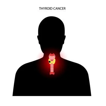 Thyroid cancer stages Illustrazione stock