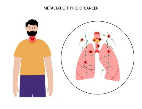 Thyroid cancer stages Stock Illustration