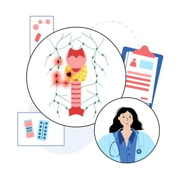 Thyroid cancer stages Stock Illustration