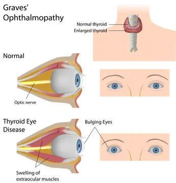 Thyroid eye disease Illustrazione stock