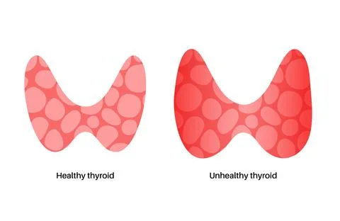 Thyroid gland disease Stock Illustration