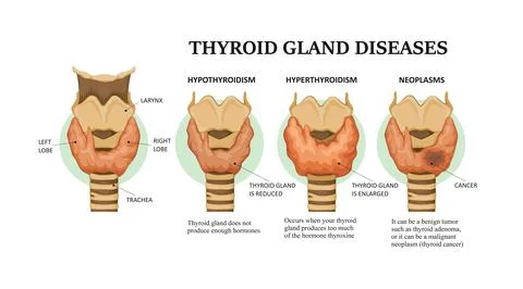 Thyroid gland diseases - hyperthyroidism, hypothyroidism and neoplasms Stock Illustration