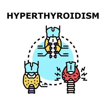 Thyroid gland experiencing hyperthyroidism with medical illustration Stock Illustration