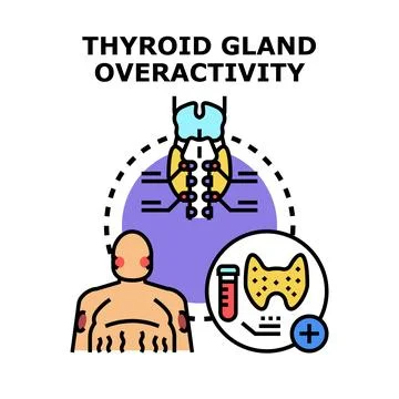Thyroid gland overactivity leading to hyperthyroidism symptoms Stock Illustration