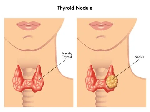 Thyroid nodule Stock Illustration