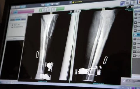 Tibia and fibula fractures X-ray of the leg of a patient who had a ski fal... Stock Photos