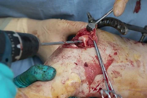 Tibia Bone Drill Close-up 写真素材