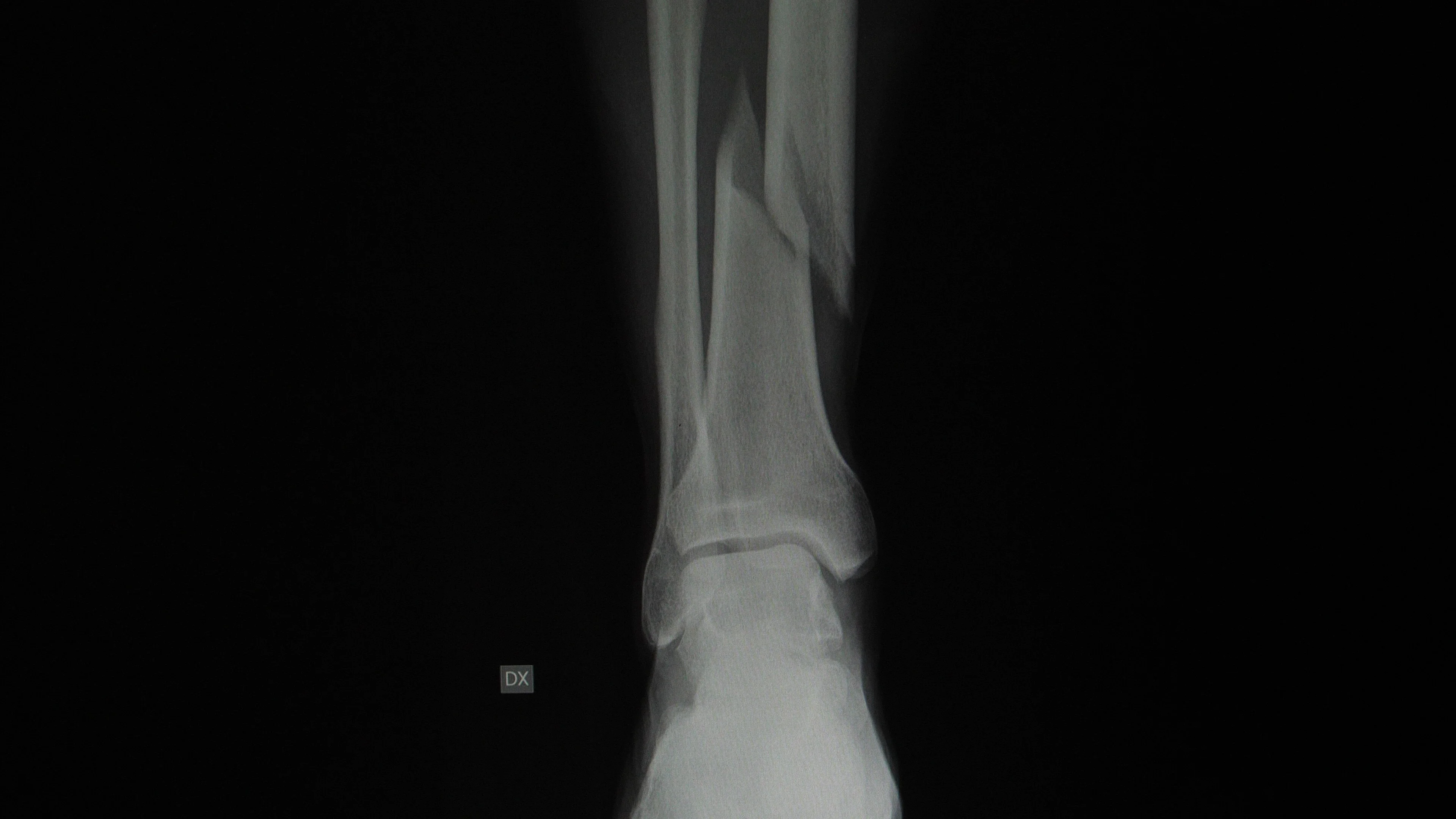 compound fracture x ray