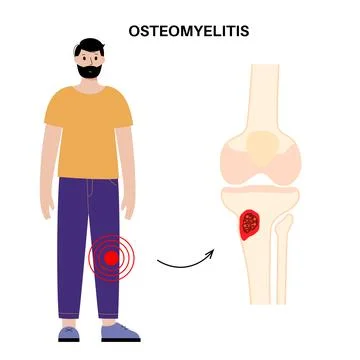 Tibia bone osteomyelitis Stock Illustration