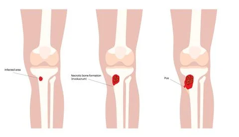 Tibia bone osteomyelitis Illustrazione stock