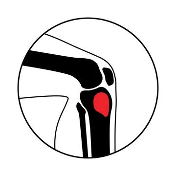 Tibia bone osteomyelitis Illustrazione stock