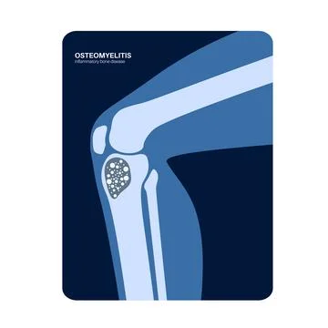 Tibia bone osteomyelitis Illustrazione stock
