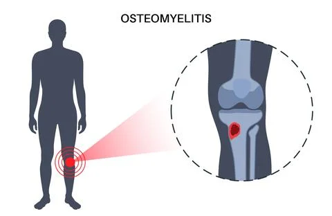 Tibia bone osteomyelitis Illustrazione stock