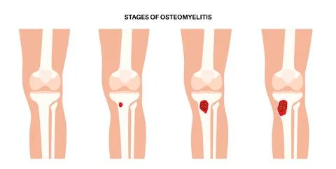 Tibia bone osteomyelitis Illustrazione stock