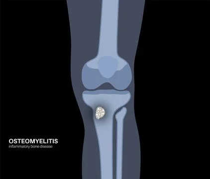 Tibia bone osteomyelitis Illustrazione stock