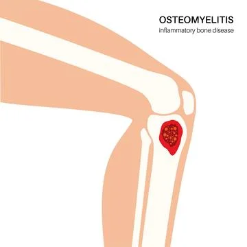 Tibia bone osteomyelitis Stock Illustration