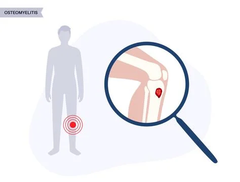 Tibia bone osteomyelitis Illustrazione stock