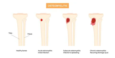 Tibia bone osteomyelitis Illustrazione stock