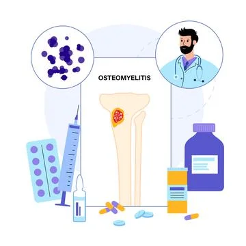 Tibia bone osteomyelitis Illustrazione stock