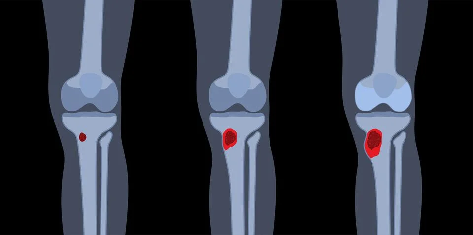 Tibia bone osteomyelitis Illustrazione stock