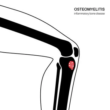 Tibia bone osteomyelitis Illustrazione stock