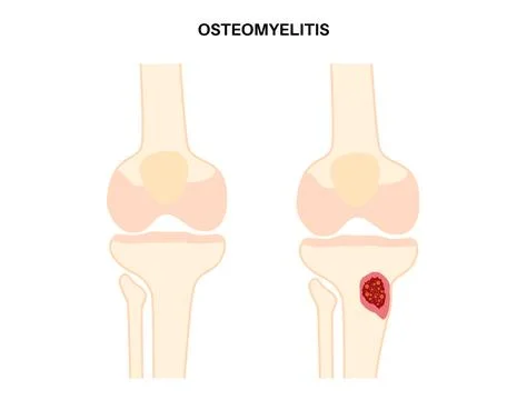 Tibia bone osteomyelitis Illustrazione stock