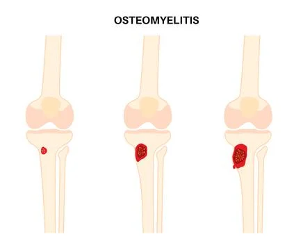 Tibia bone osteomyelitis Stock Illustration