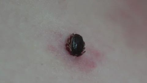 Tick Attached to Human Skin With Red Bite Reaction Macro Stock Footage 342169172