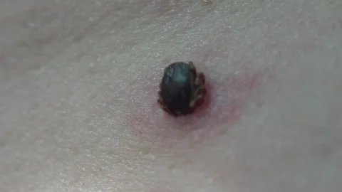 Tick Attached to Human Skin with Redness Around the Bite Macro Stock Footage 342145631
